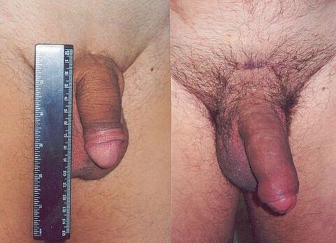 penis length before and after enlargement surgery