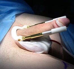 How penis enlargement surgery is performed